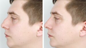 Les effets d'une rhinoplastie par fils tenseurs