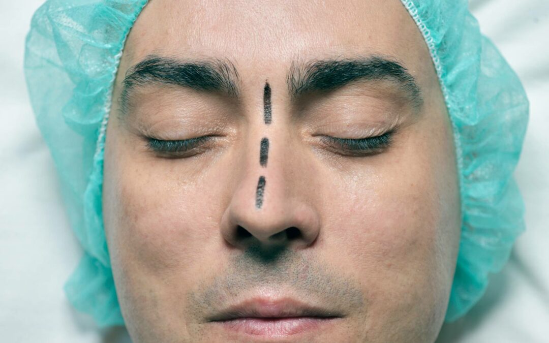 La rhinoplastie par fils tenseurs