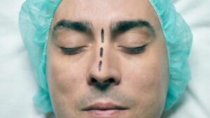La rhinoplastie par fils tenseurs