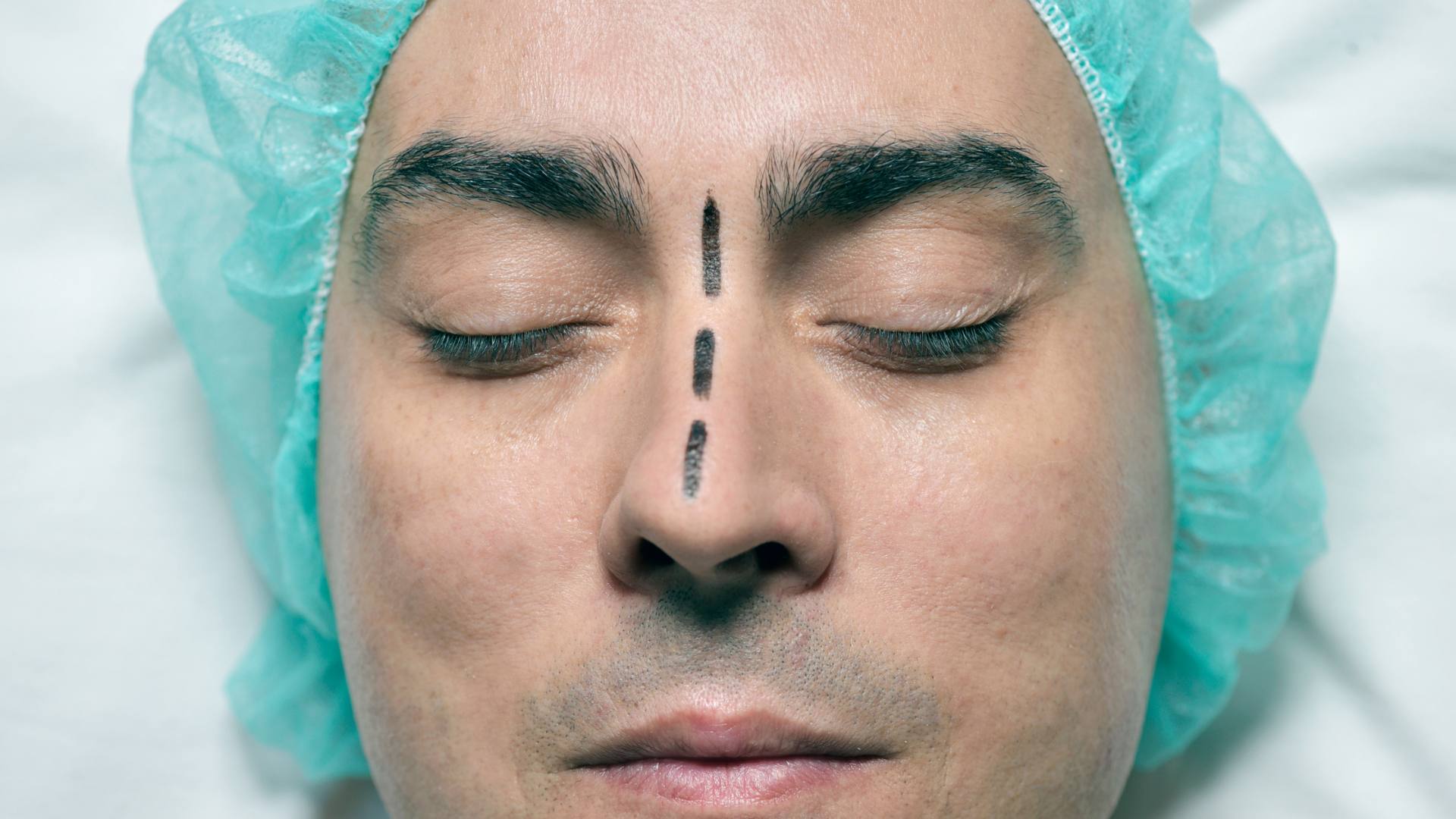 La rhinoplastie par fils tenseurs